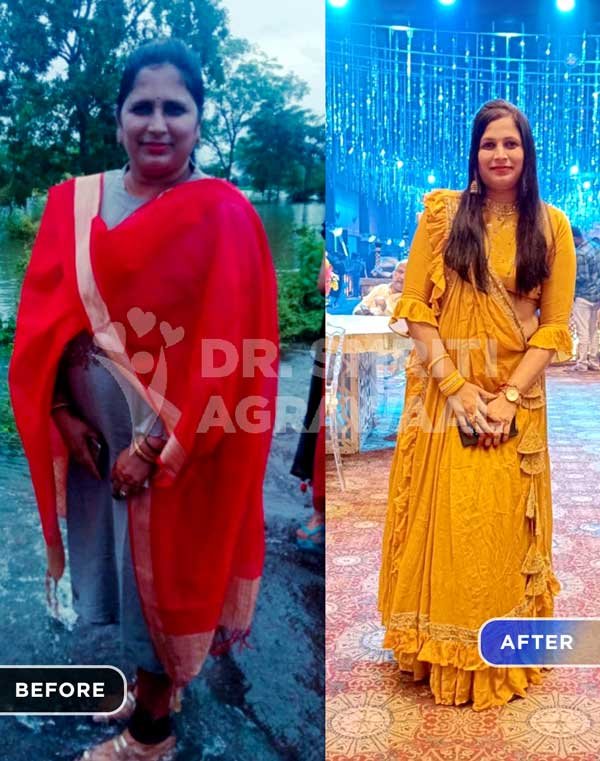 Dr Smriti Agrawaal - Nutritionist and Weight Loss Review - Ruchika Agrawal loss 14 kg in 3 months